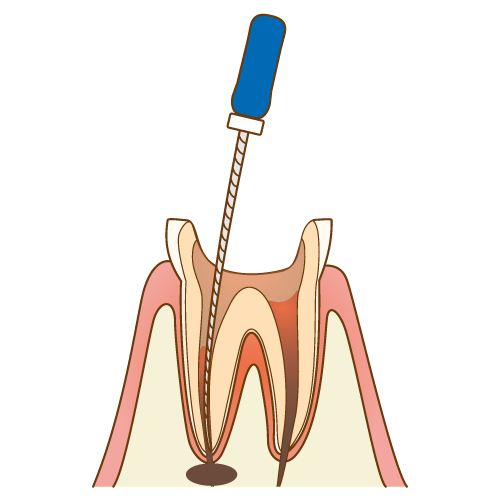 根管治療の流れ