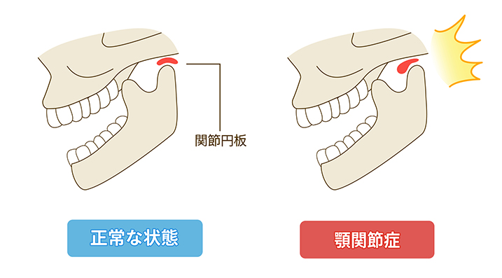 顎関節症