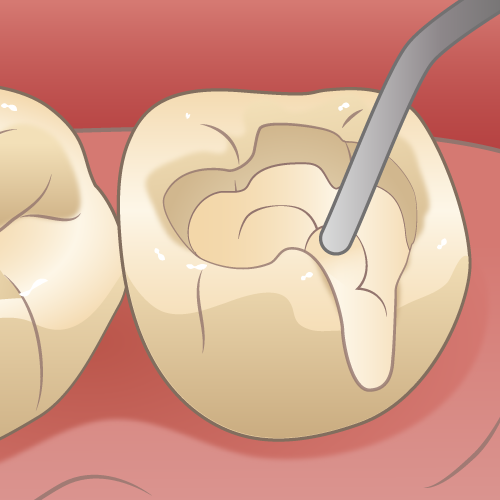 見た目も綺麗なむし歯治療